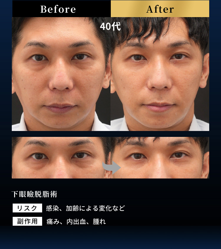Before After 40代 下眼瞼脱脂術 リスク 感染、加齢による変化など 副作用 痛み、内出血、腫れ