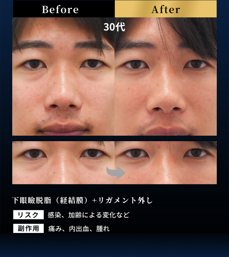 Before After 30代 下眼瞼脱脂術(経結膜)＋リガメント外し リスク 感染、加齢による変化など 副作用 痛み、内出血、腫れ