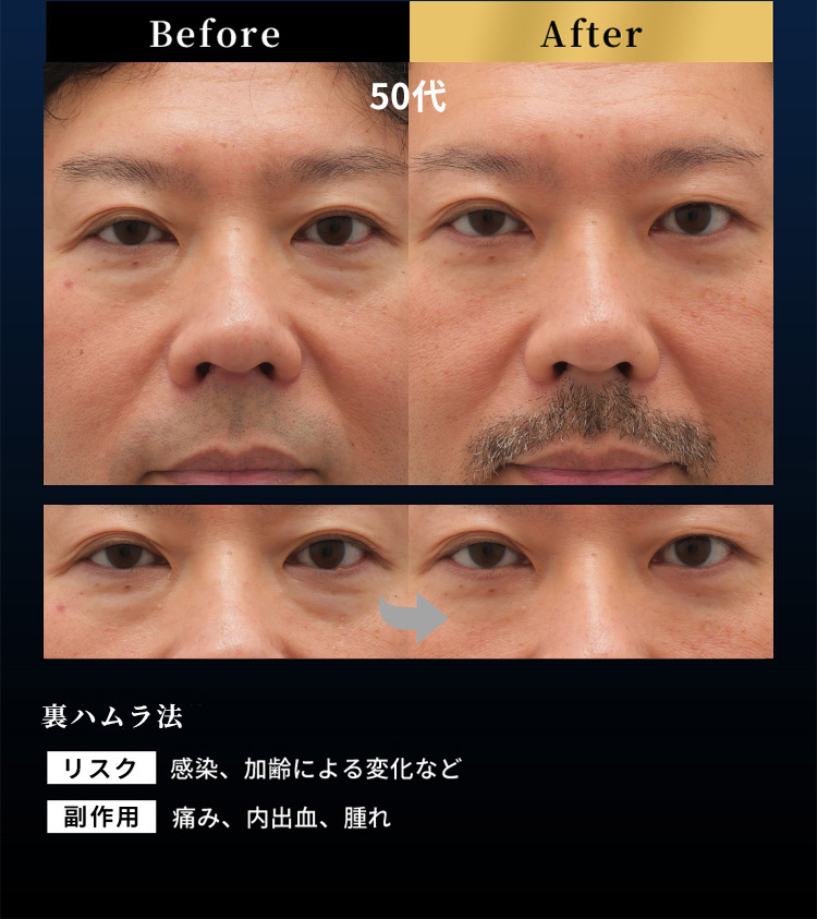 Before After 50代 裏ハムラ法 リスク 感染、加齢による変化など 副作用 痛み、内出血、腫れ