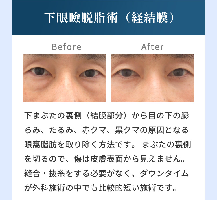 下眼瞼脱脂術（経結膜） Before After 下まぶたの裏側（結膜部分）から目の下の膨らみ、たるみ、赤クマ、黒クマの原因となる眼窩脂肪を取り除く方法です。まぶたの裏側を切るので、傷は皮膚表面から見えません。縫合・抜糸をする必要がなく、ダウンタイムが外科施術の中でも比較的短い施術です