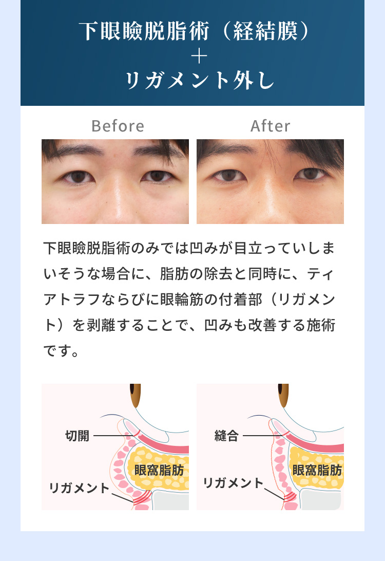 下眼瞼脱脂術（経結膜）＋リガメント外し Before After 下眼瞼脱脂術のみでは凹みが目立っていしまいそうな場合に、脂肪の除去と同時に、ティアトラフならびに眼輪筋の付着部（リガメント）を剥離することで、凹みも改善する施術です。切開 リガメント 縫合 リガメント 眼窩脂肪