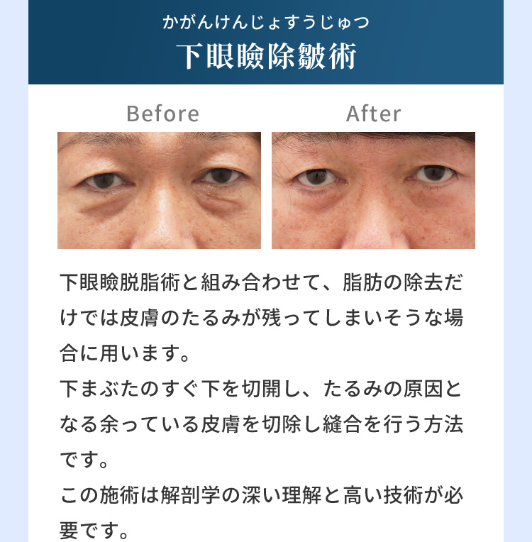 かがんけんじょすうじゅつ 下眼瞼除皺術 Before After 下眼瞼脱脂術と組み合わせて、脂肪の除去だけでは皮膚のたるみが残ってしまいそうな場合に用います。下まぶたのすぐ下を切開し、たるみの原因となる余っている皮膚を切除し縫合を行う方法です。この施術は解剖学の深い理解と高い技術が必要です。下眼瞼除皺術について詳しくはこちら
