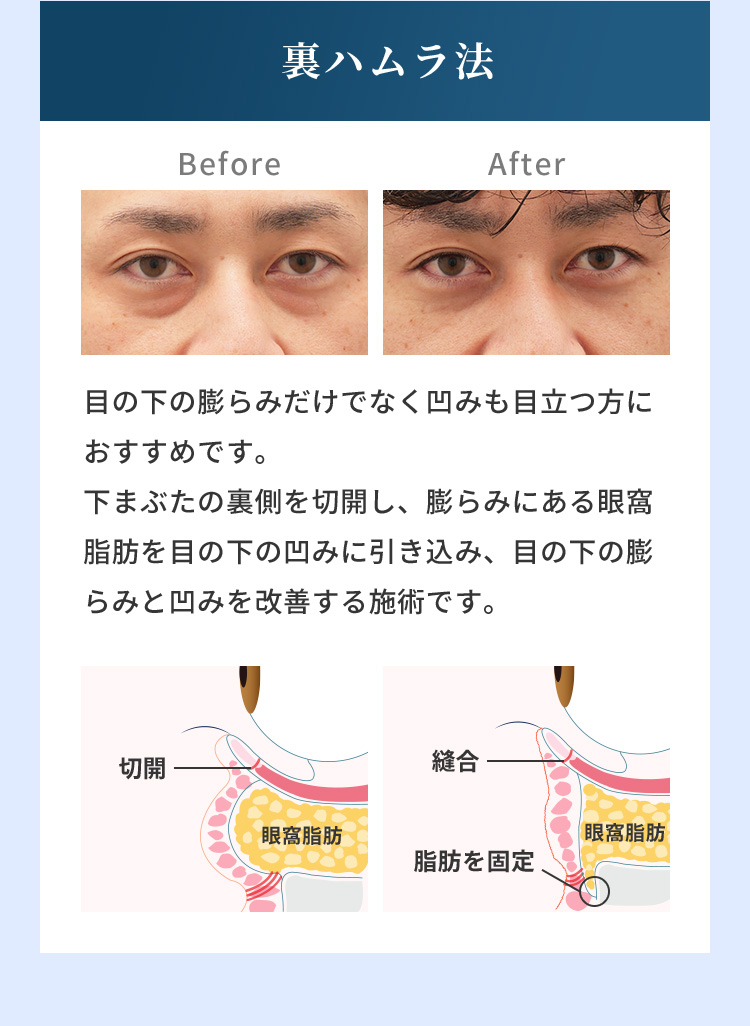 裏ハムラ法 Before After 目の下の膨らみだけでなく凹みも目立つ方におすすめです。下まぶたの裏側を切開し、膨らみにある眼窩脂肪を目の下の凹みに引き込み、目の下の膨らみと凹みを改善する施術です。切開 縫合 脂肪を固定 眼窩脂肪