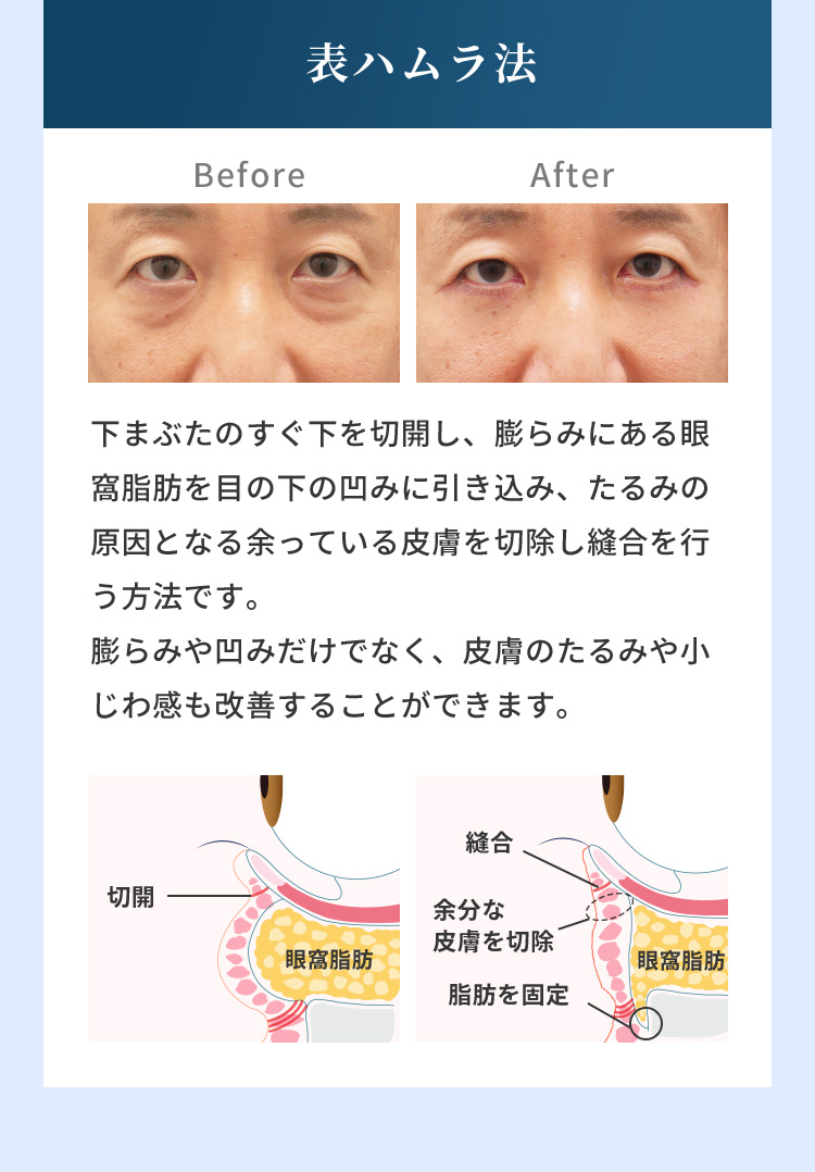 表ハムラ法 Before After 下まぶたのすぐ下を切開し、膨らみにある眼窩脂肪を目の下の凹みに引き込み、たるみの原因となる余っている皮膚を切除し縫合を行う方法です。膨らみや凹みだけでなく、皮膚のたるみや小じわ感も改善することができます。切開 眼窩脂肪 縫合 余分な皮膚を切除 脂肪を固定 眼窩脂肪