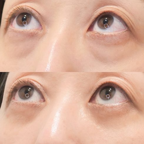 下眼瞼脱脂術（経結膜法）の症例写真
