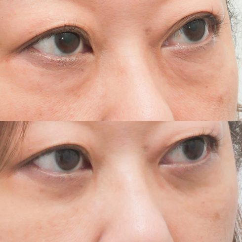 目の下のたるみ取り 症例写真