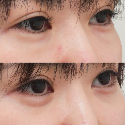 下眼瞼脱脂は保険適用で受けられる ドクターブログ 目の下のたるみ取りなら東京イセアクリニック
