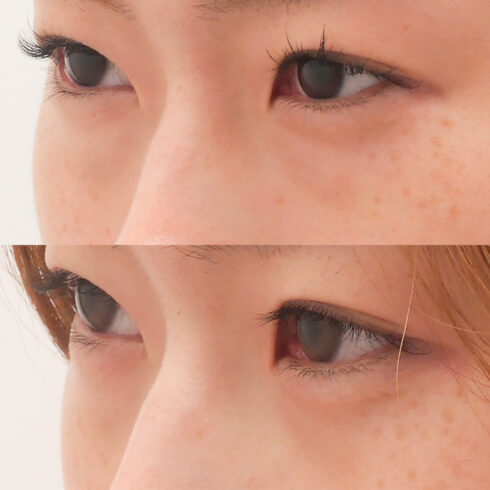 目の下のクマ・たるみ取り 症例写真