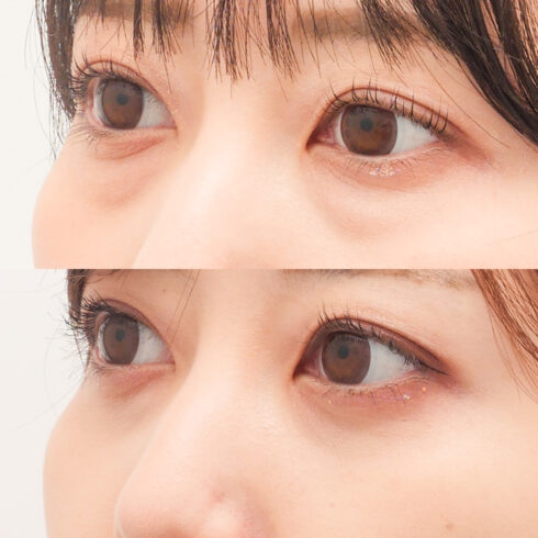 目の下のクマ・たるみ取り その他の症例写真