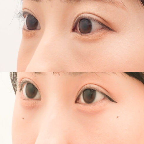 目の下のクマ・たるみ取り その他の症例写真