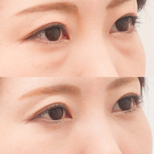 目の下のクマ・たるみ取り その他の症例写真