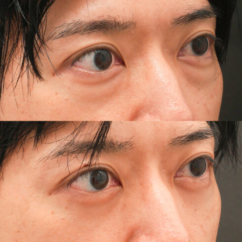 目の下のクマ・たるみ取り その他の症例写真