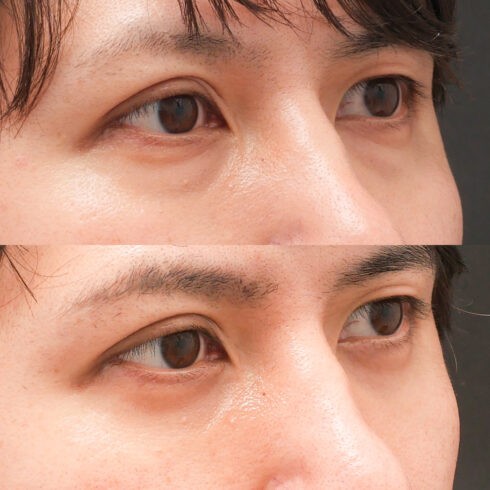 目の下のクマ・たるみ取り その他の症例写真