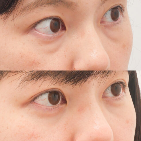 目の下のクマ・たるみ取り その他の症例写真