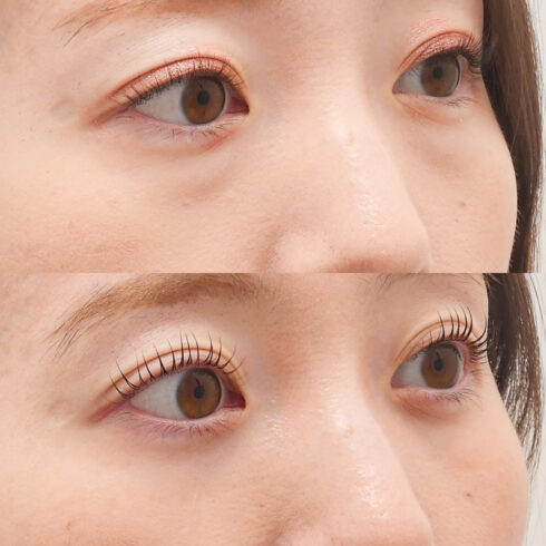 目の下のクマ・たるみ取り その他の症例写真