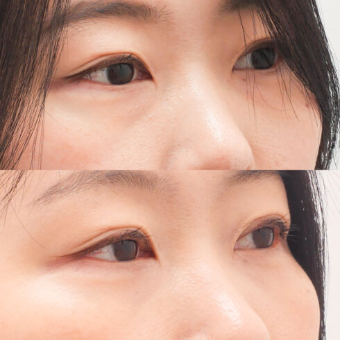 目の下のクマ・たるみ取り その他の症例写真