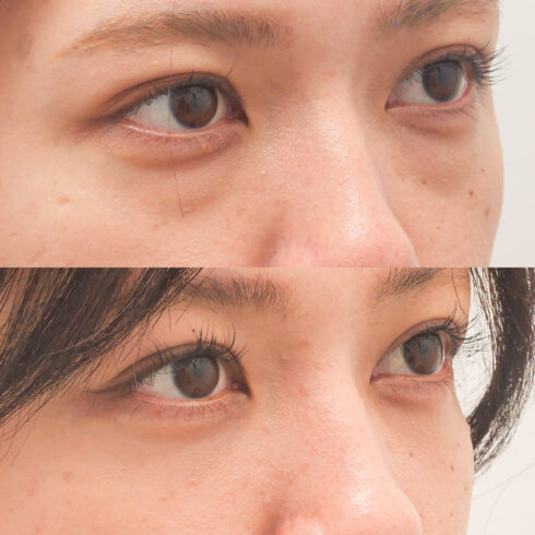 目の下のクマ・たるみ取り その他の症例写真