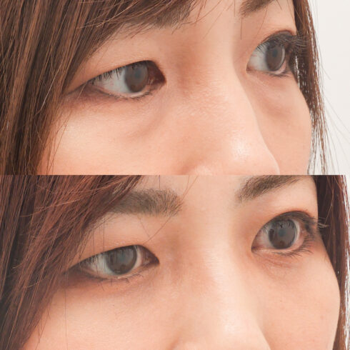 目の下のクマ・たるみ取り その他の症例写真