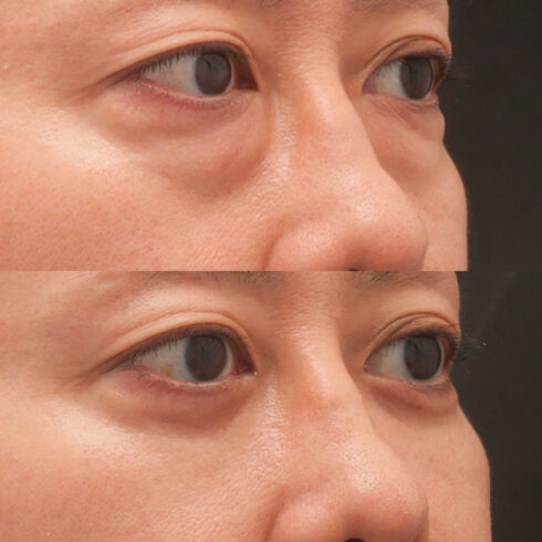 目の下のクマ・たるみ取り その他の症例写真