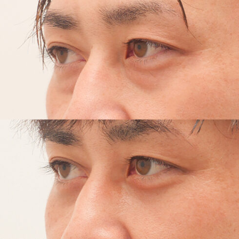 目の下のクマ・たるみ取り その他の症例写真