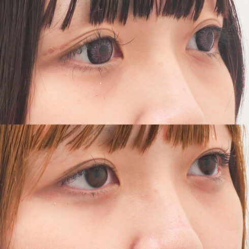 目の下のクマ・たるみ取り その他の症例写真