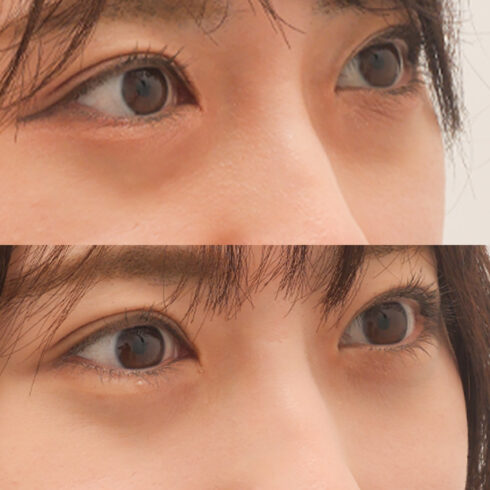 目の下のクマ・たるみ取り その他の症例写真