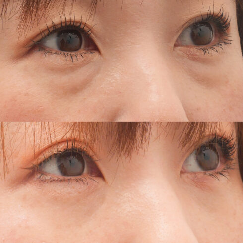 目の下のクマ・たるみ取り その他の症例写真