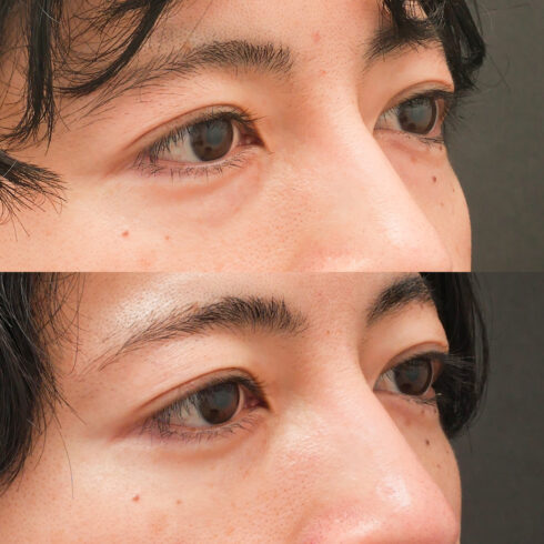 目の下のクマ・たるみ取り その他の症例写真