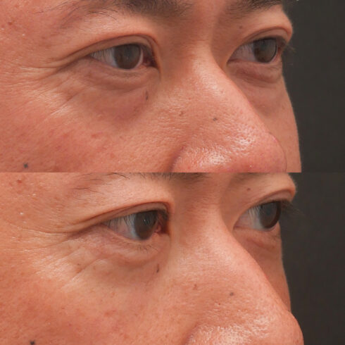 目の下のクマ・たるみ取り その他の症例写真