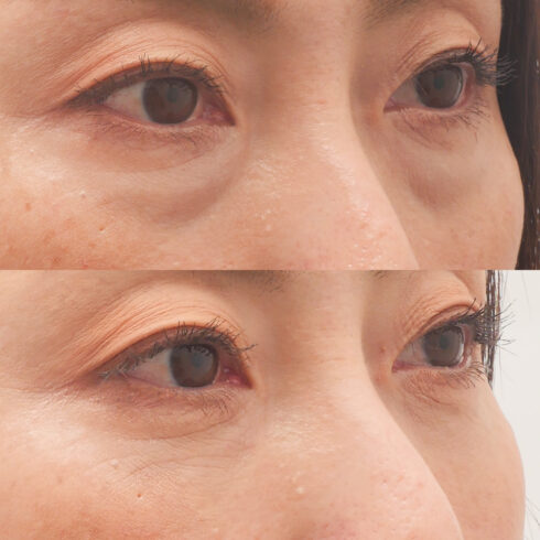 目の下のクマ・たるみ取り その他の症例写真