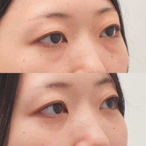 目の下のクマ・たるみ取り その他の症例写真