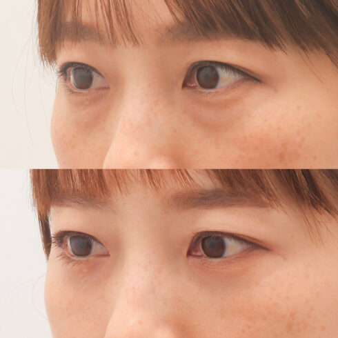 目の下のクマ・たるみ取り その他の症例写真
