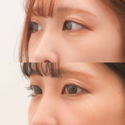目の下のクマ・たるみ取り その他の症例写真
