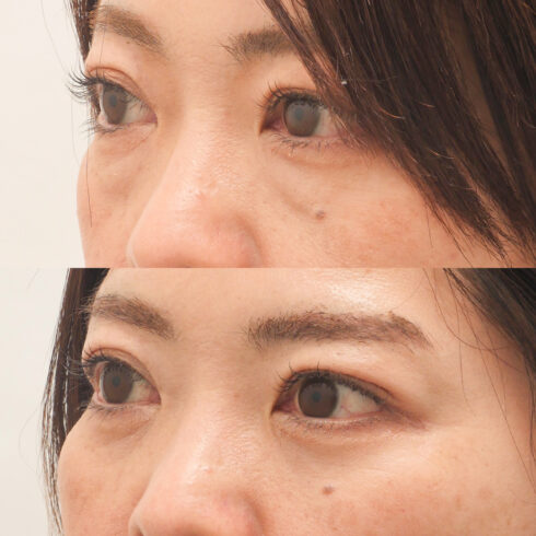 目の下のクマ・たるみ取り その他の症例写真