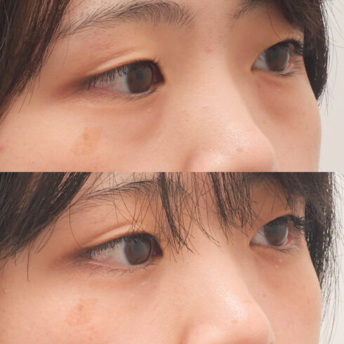 目の下のクマ・たるみ取り その他の症例写真