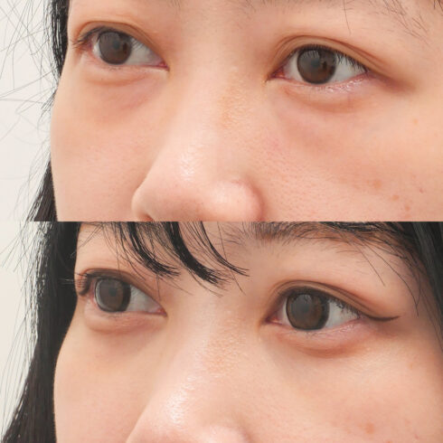 目の下のクマ・たるみ取り その他の症例写真