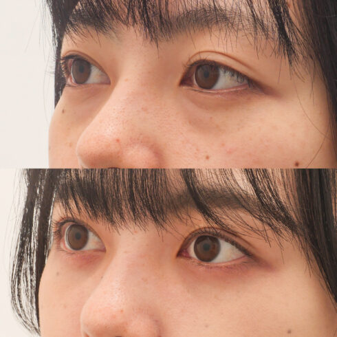 目の下のクマ・たるみ取り その他の症例写真