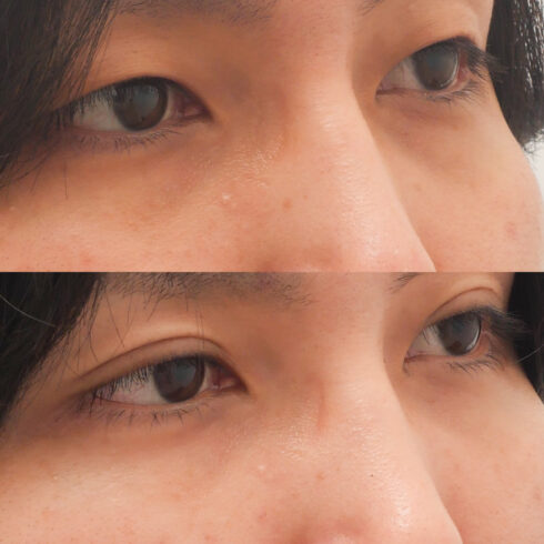 目の下のクマ・たるみ取り その他の症例写真