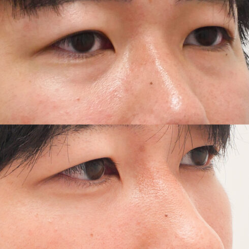 目の下のクマ・たるみ取り その他の症例写真