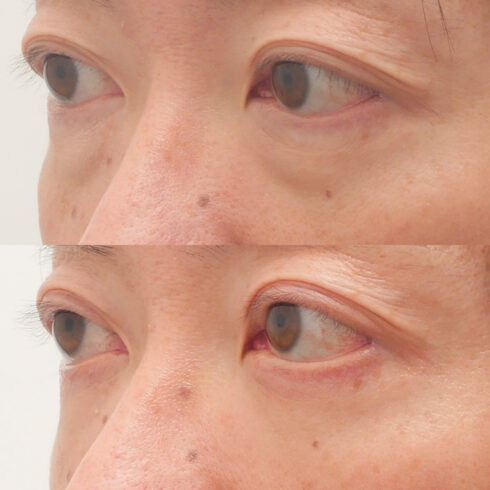 目の下のクマ・たるみ取り その他の症例写真