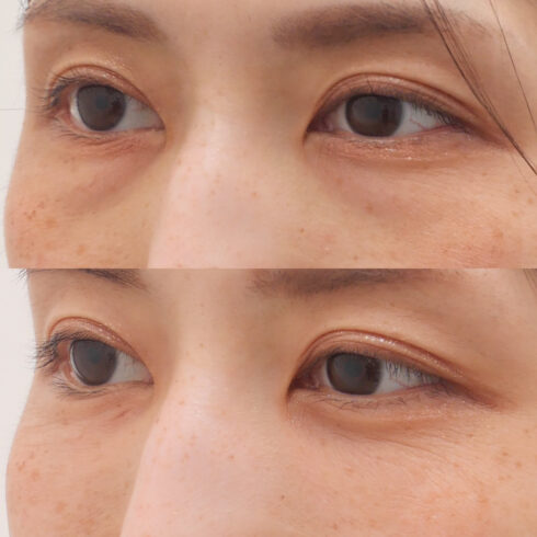 目の下のクマ・たるみ取り その他の症例写真