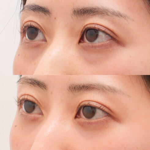 目の下のクマ・たるみ取り その他の症例写真
