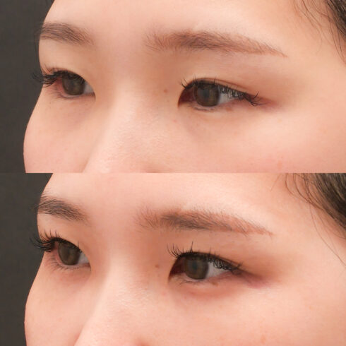 目の下のクマ・たるみ取り その他の症例写真