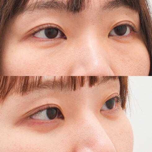 目の下のクマ・たるみ取り その他の症例写真