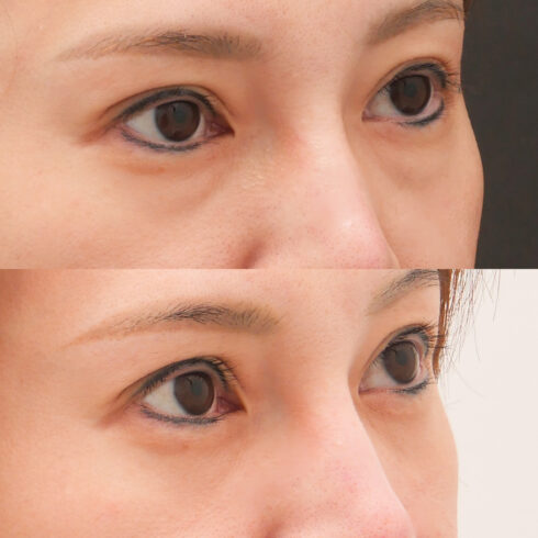 目の下のクマ・たるみ取り その他の症例写真