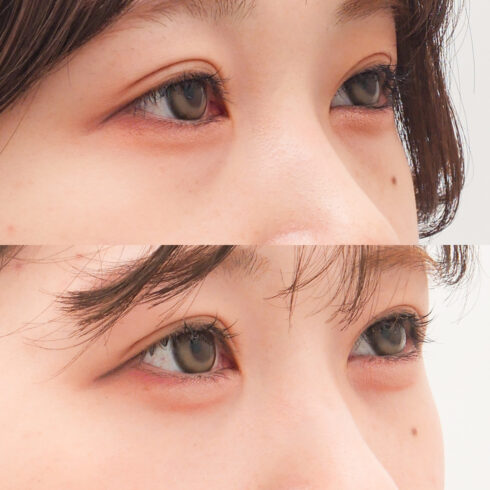 目の下のクマ・たるみ取り その他の症例写真