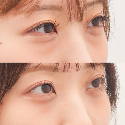 目の下のクマ・たるみ取り その他の症例写真