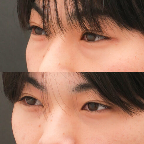 目の下のクマ・たるみ取り その他の症例写真