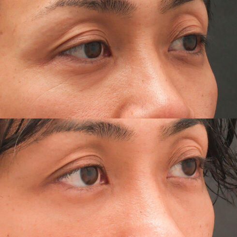 目の下のクマ・たるみ取り その他の症例写真